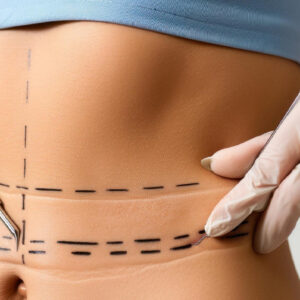 شد البطن ونحت الخصر